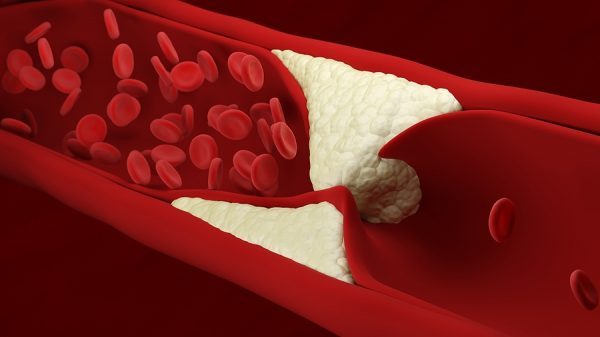 How Arterial Plaques Can Turn Deadly