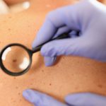 Gloved Doctor Dermatologist With Magnifying Glass Examines Pigme