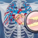 Arterial Plaques